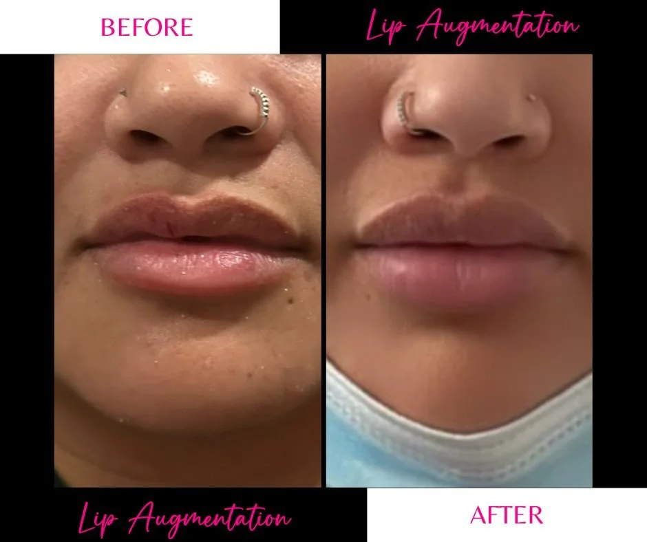 Side-by-side comparison showing a woman's lips before and after lip augmentation. The 'before' side has fuller lips with some dryness, while the 'after' side shows smoother, more defined lips. The woman is wearing a nose ring and a face mask pulled d