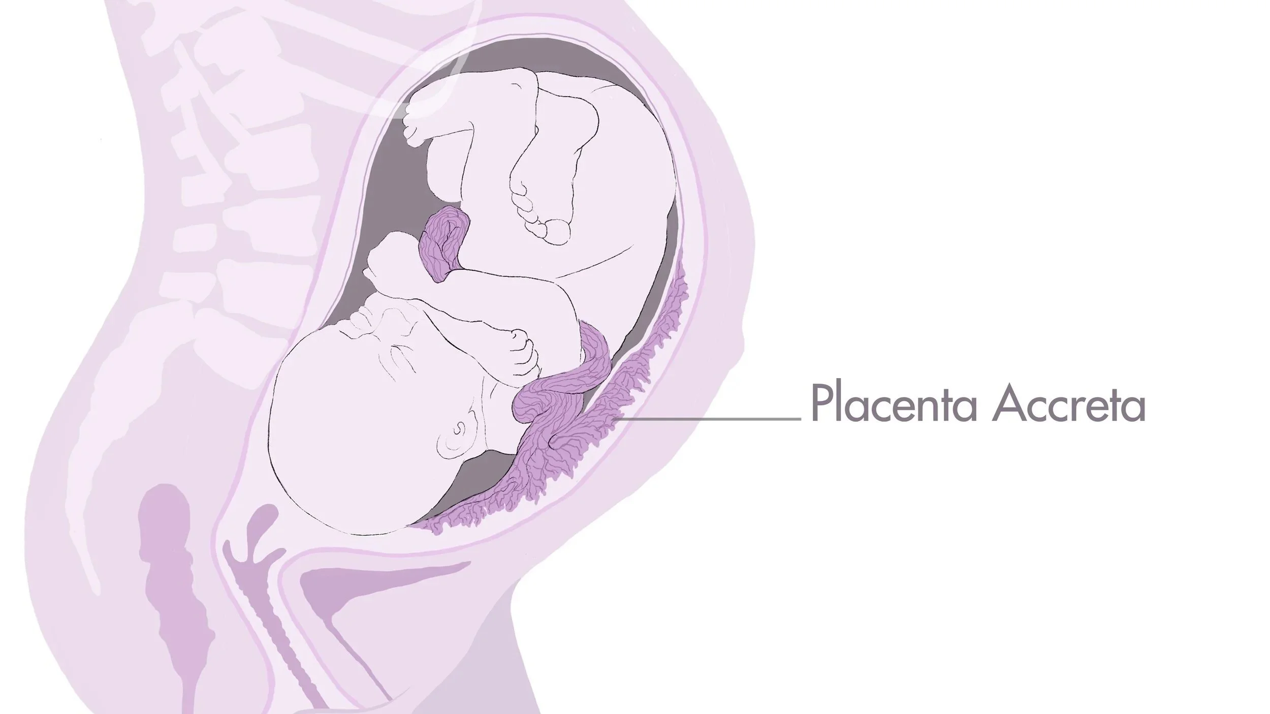 Placenta Accreta Scotland