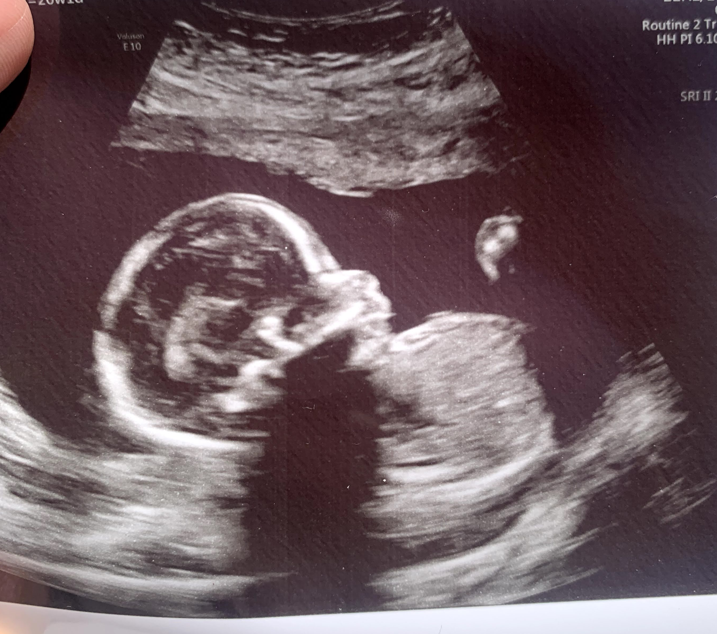 an ultrasound of baby