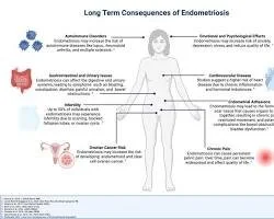 Diagram of long-term consequences of endometriosis, including effects on the brain, reproductive organs, digestive and urinary systems, and the impact on mental health, fertility, and overall well-being.