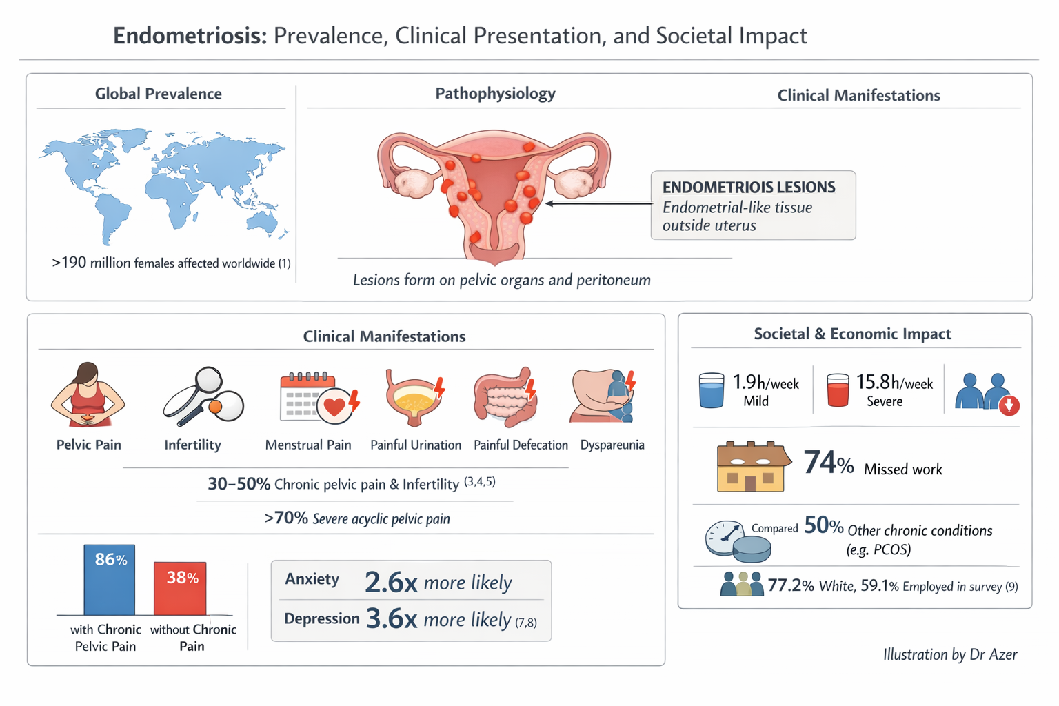 Infographic on endometriosis highlighting prevalence, clinical presentation, and societal impact. Shows a world map indicating over 190 million affected women, diagram of pelvic organs with endometriosis lesions, symptoms like pelvic pain, infertility, menstrual pain, painful urination, bowel pain, and dyspareunia. Includes statistics on chronic pelvic pain, anxiety, and depression, and societal impacts such as missed work and economic costs.