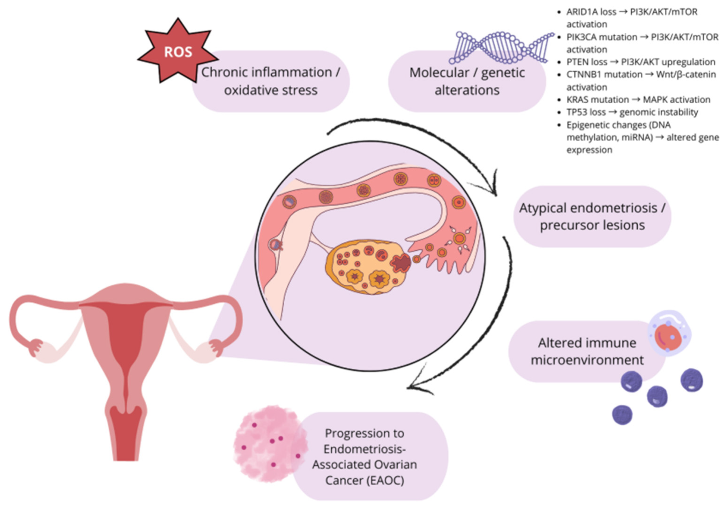Diagram illustrating the progression of endometriosis to ovarian cancer, showing factors like chronic inflammation, molecular alterations, atypical lesions, altered immune microenvironment, and genetic mutations affecting the ovaries and endometrial 