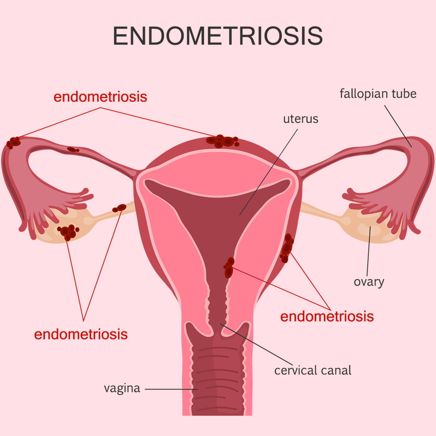 Diagram of the female reproductive system showing endometriosis in the uterus, ovaries, fallopian tubes, and vagina.