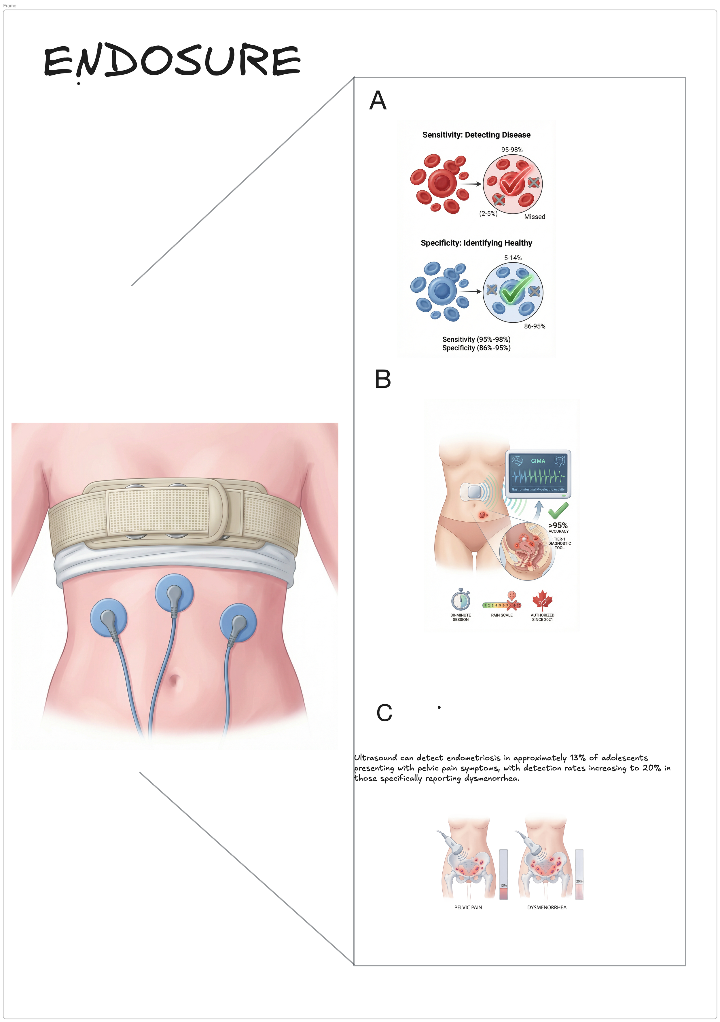 Endometriosis is a challenging condition to diagnose, particularly in adolescents experiencing pelvic pain. Ultrasound can detect endometriosis in about 13% of these cases, with detection rates rising to 20% for those reporting dysmenorrhea.

The cli