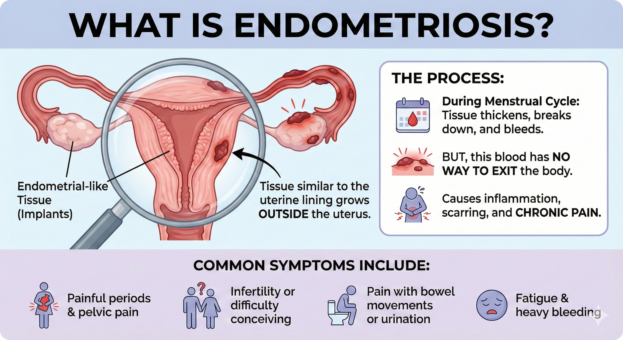 An infographic explaining endometriosis, showing a diagram of the female reproductive system with tissue similar to the uterine lining growing outside the uterus. It includes text detailing the process of tissue thickening, breakdown, and bleeding du