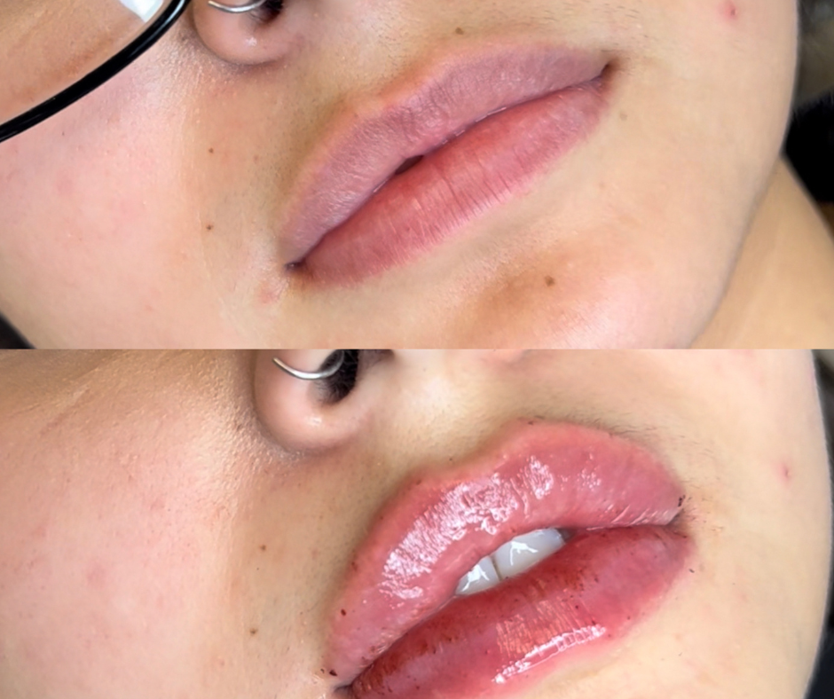 Lip Filler Before & After