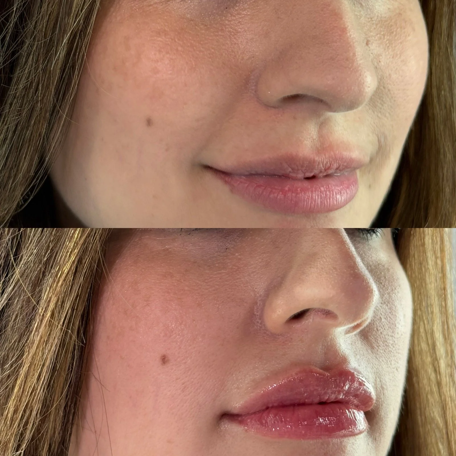 Lip Filler Versa Before & After