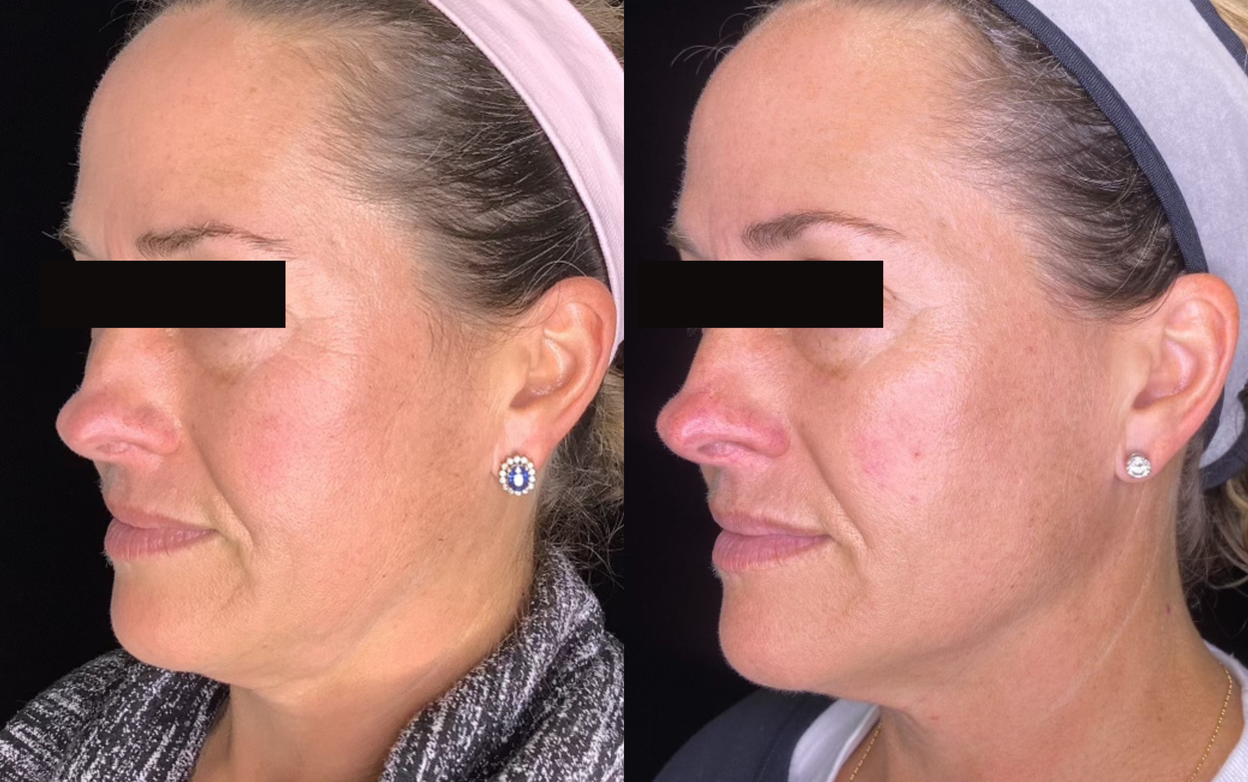 Secret RF Before & After