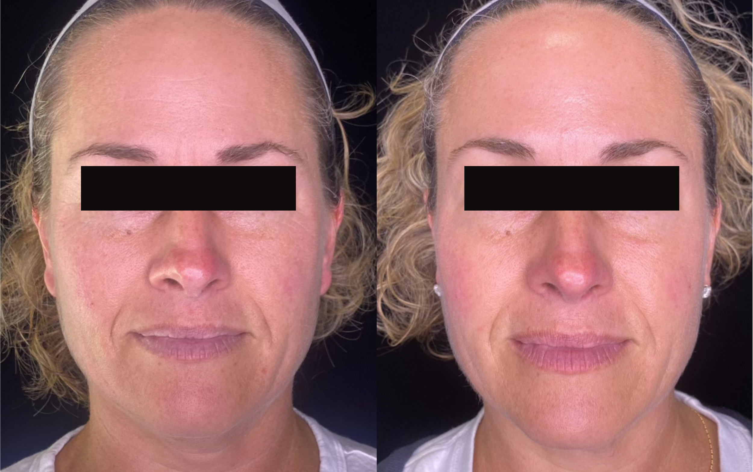 Secret RF Before & After