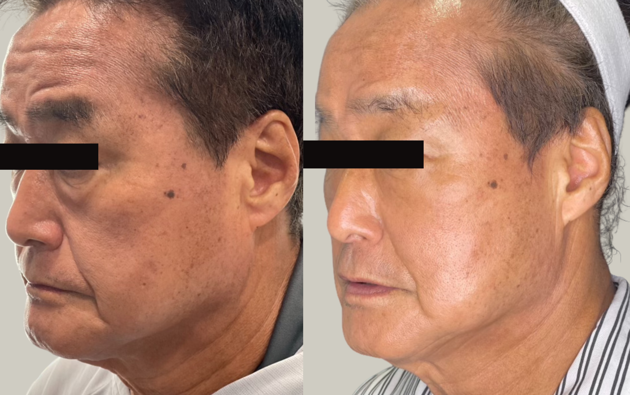 Secret RF Before & After