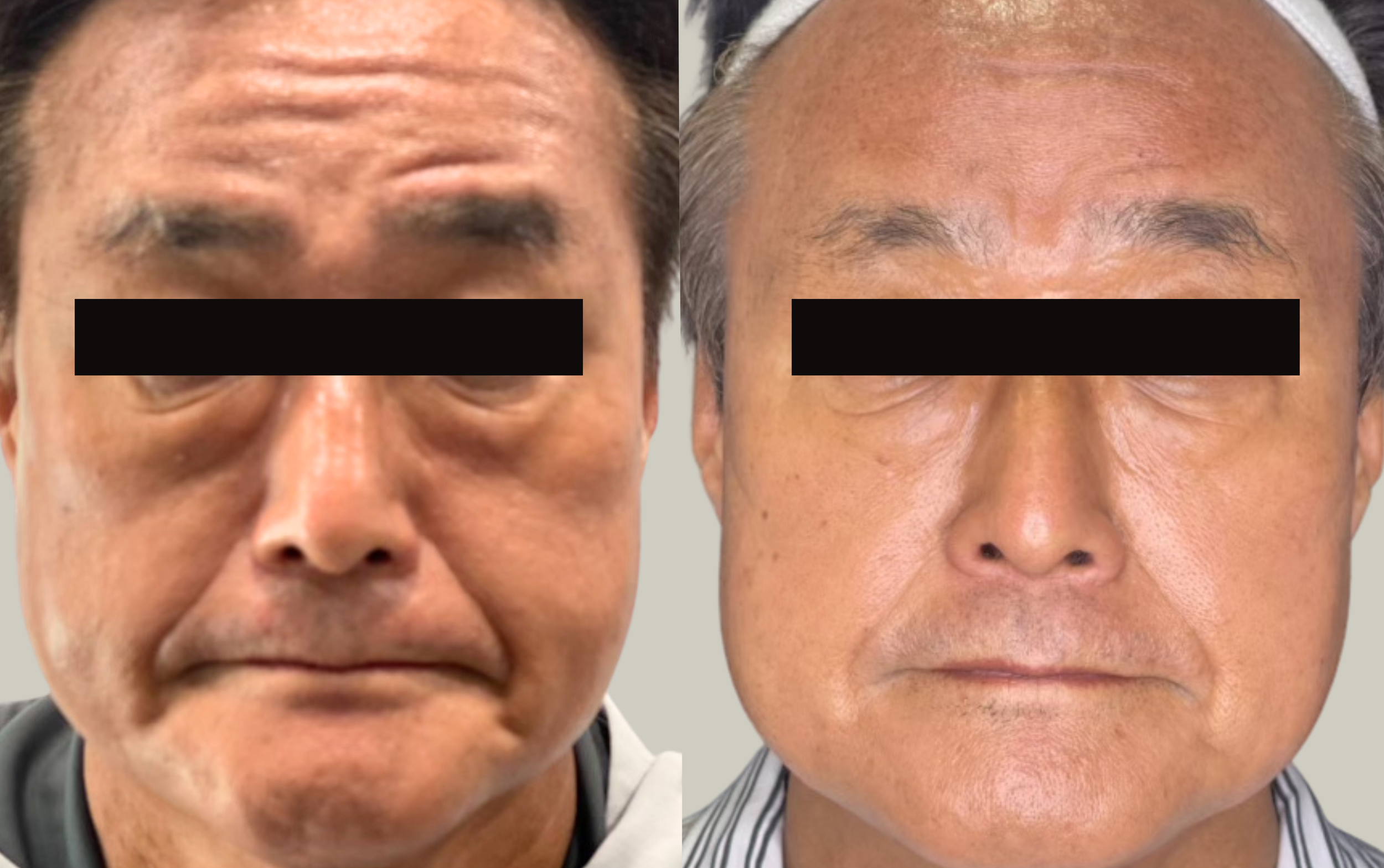 Secret RF Before & After