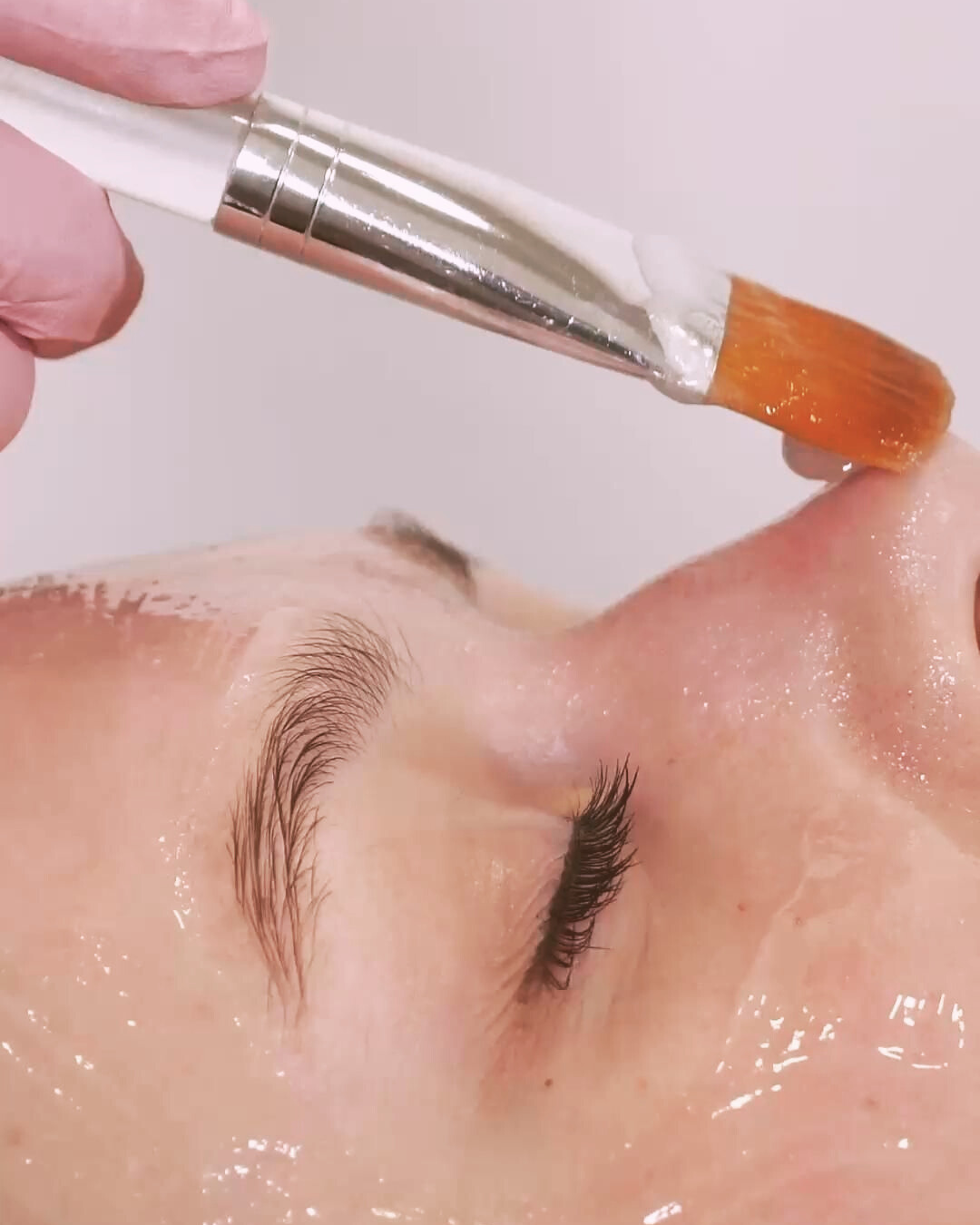 Microneedling vs. Chemical Peels: Which One Does Your Skin Actually Need?