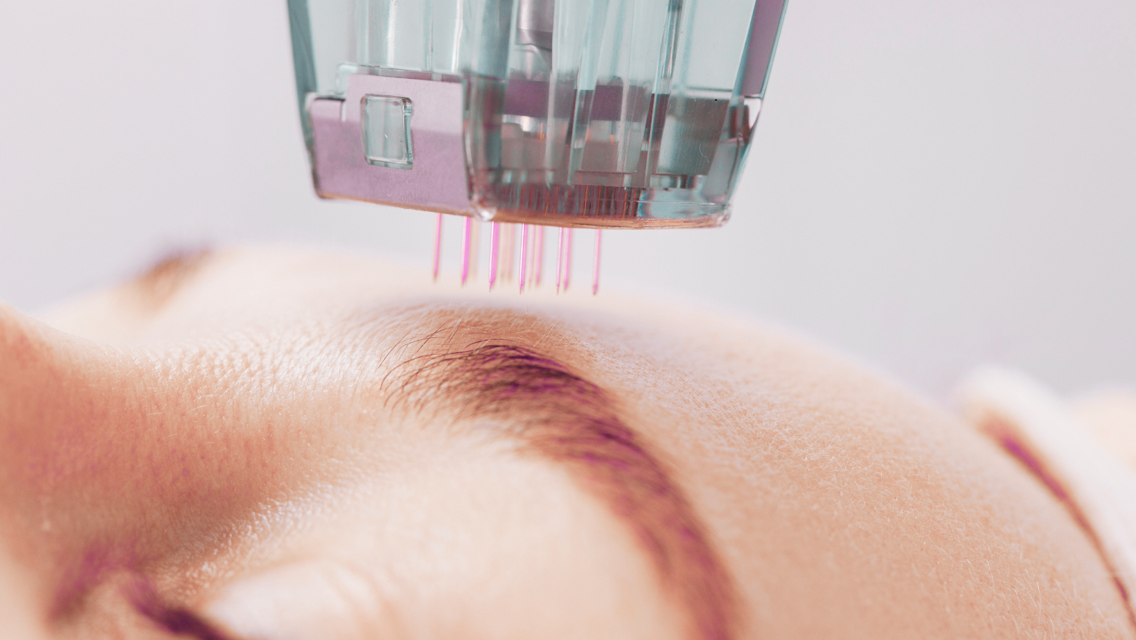 WHAT IS MICRONEEDLING?&nbsp;
