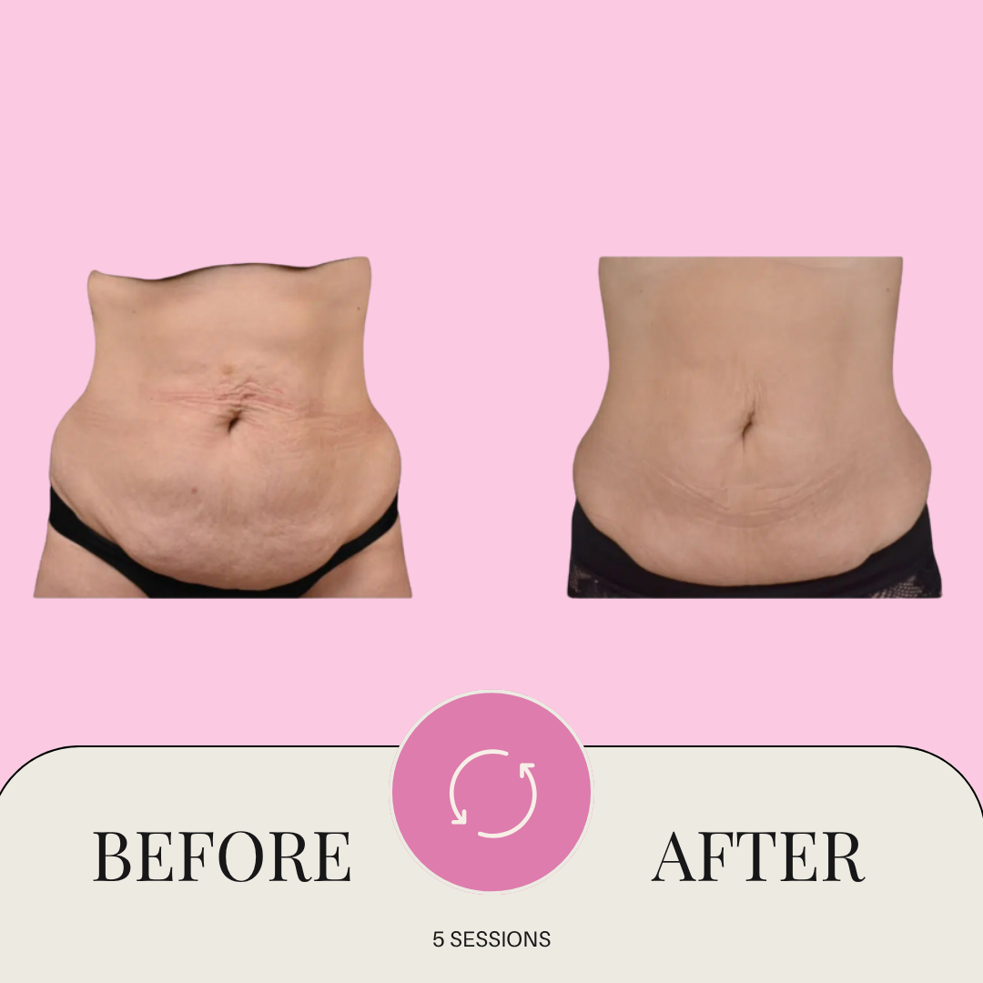 Glypo machine before & after in san antonio tx