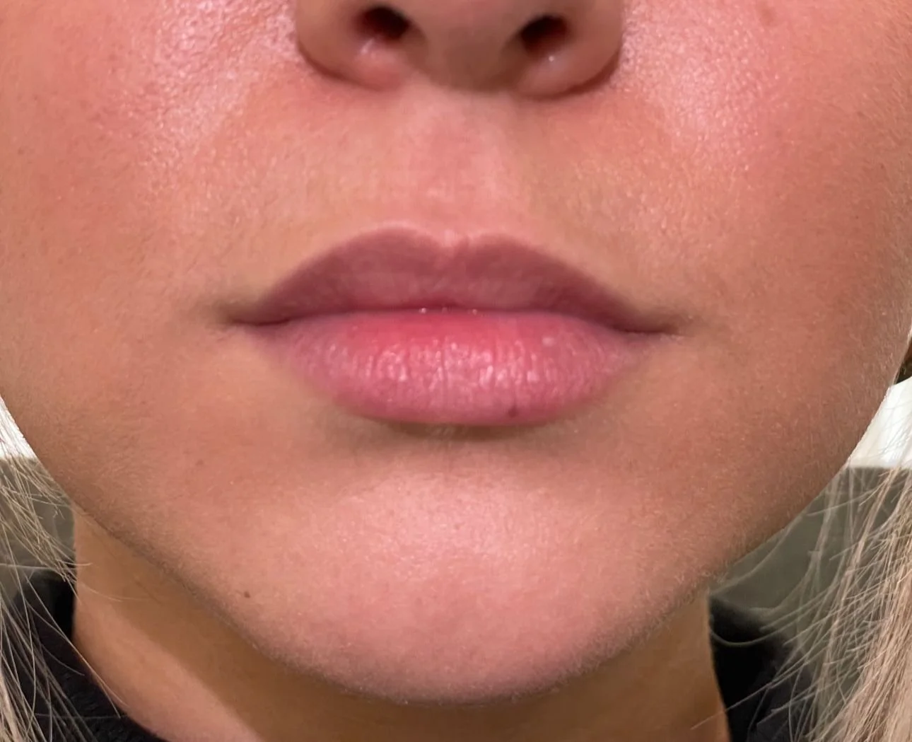 Lip Filler Before