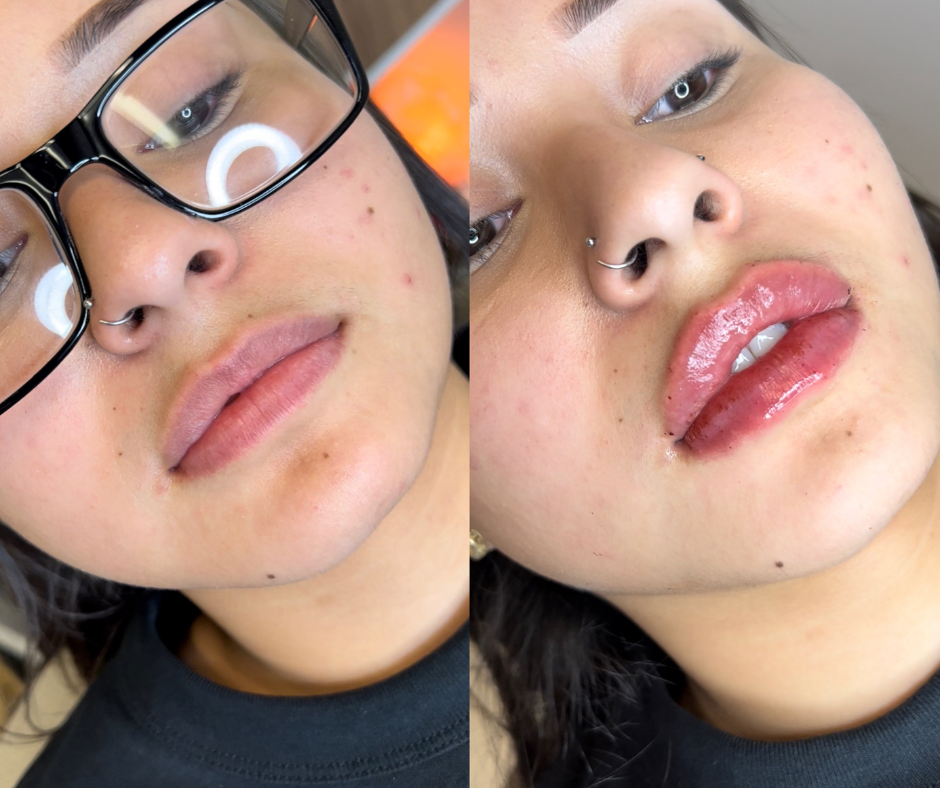 Lip Filler Before & After