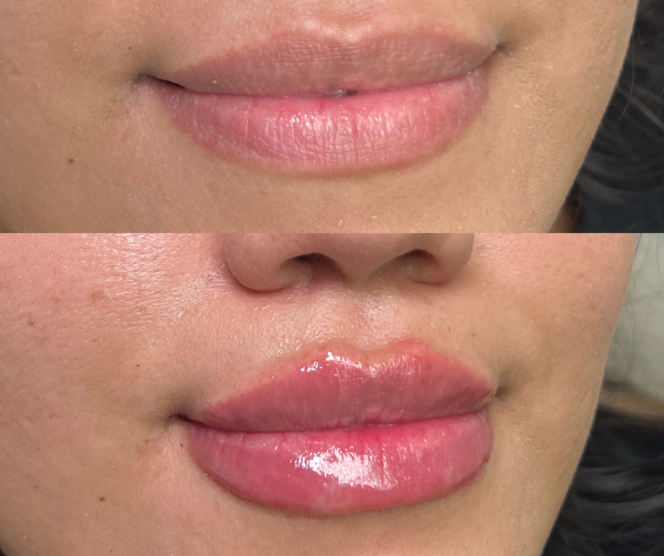 Lip Filler Before & After