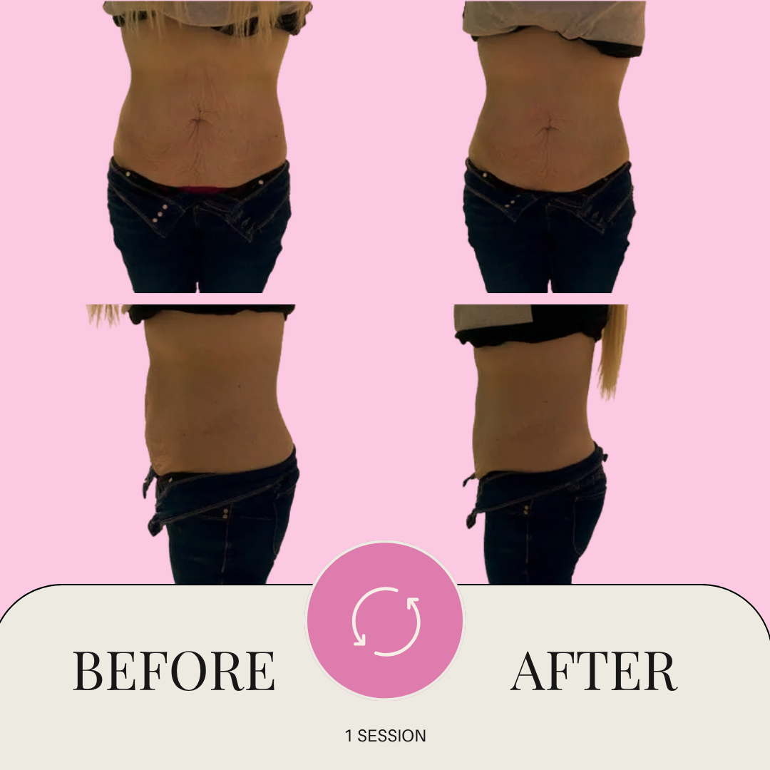 Glypo machine before & after in san antonio tx