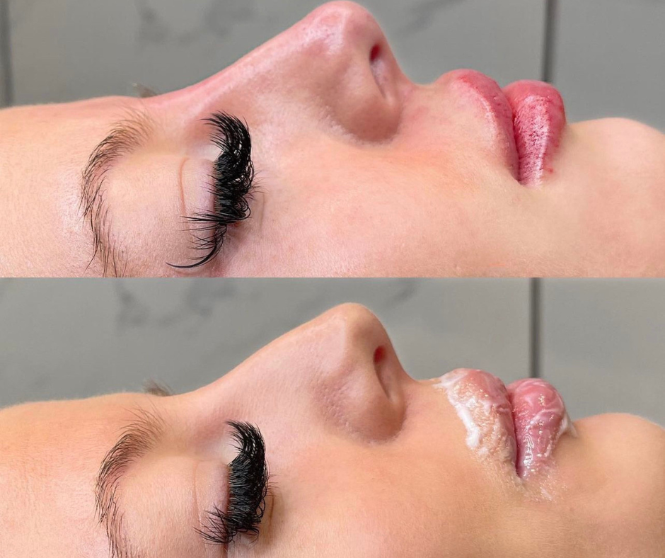 Lip Filler Before & After