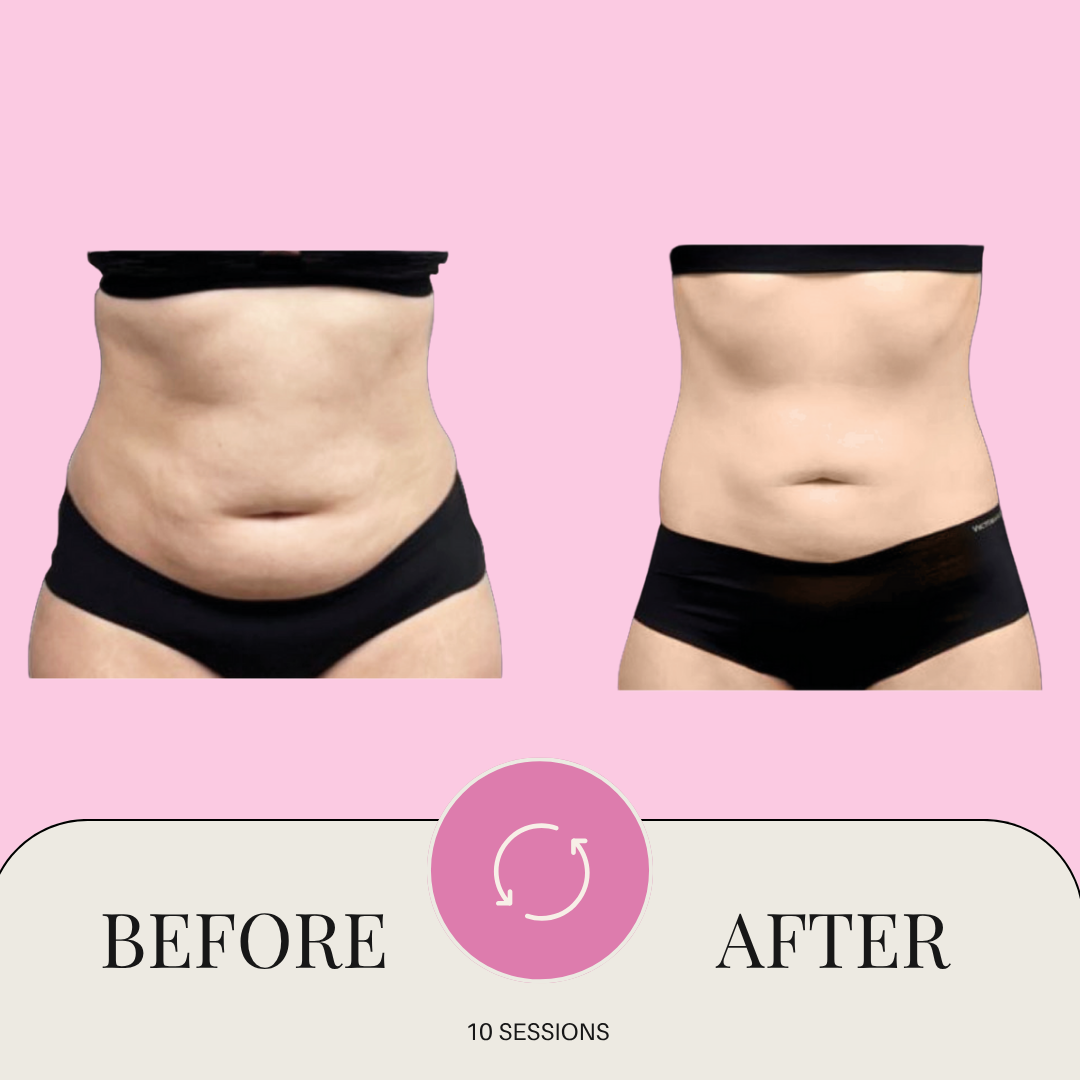 Glypo machine before & after in san antonio tx