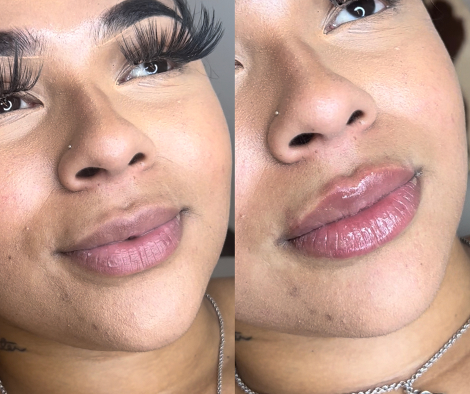Lip Filler Before & After