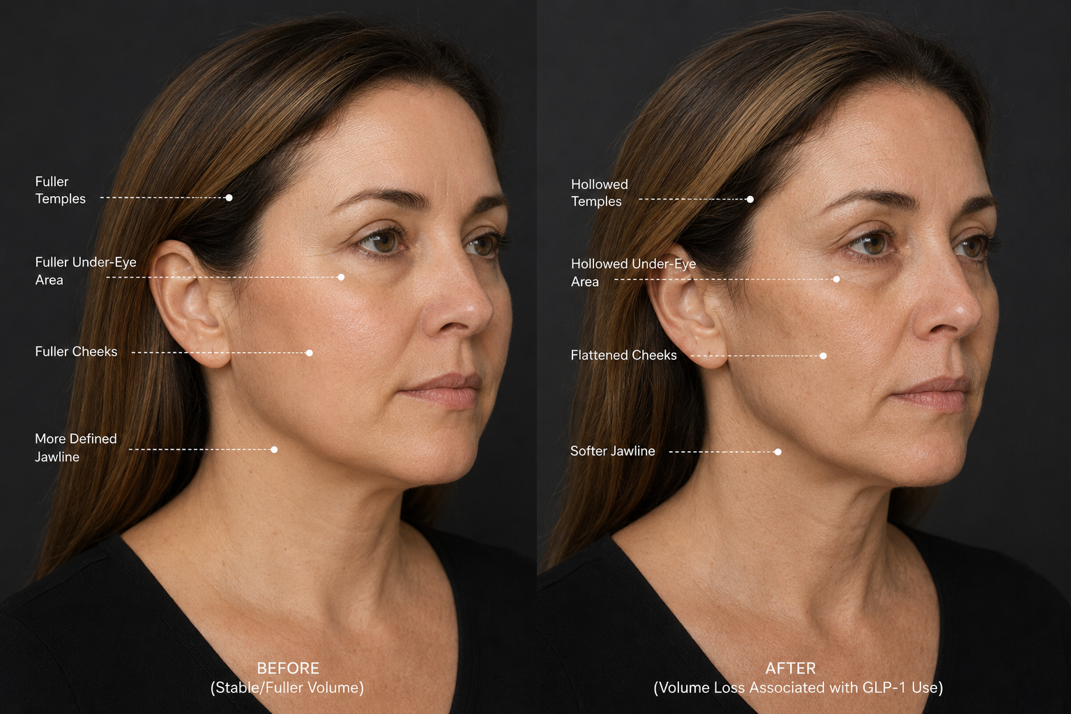 Side-by-side comparison of a woman's face before and after a cosmetic treatment, with labels indicating changes in her facial features, including fuller temples, under-eye area, cheeks, jawline, and softened jawline after treatment.
