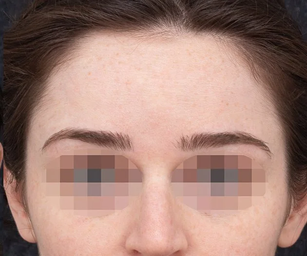 Close-up of a woman's face showing her eyebrows and forehead with pixelated eyes for privacy.