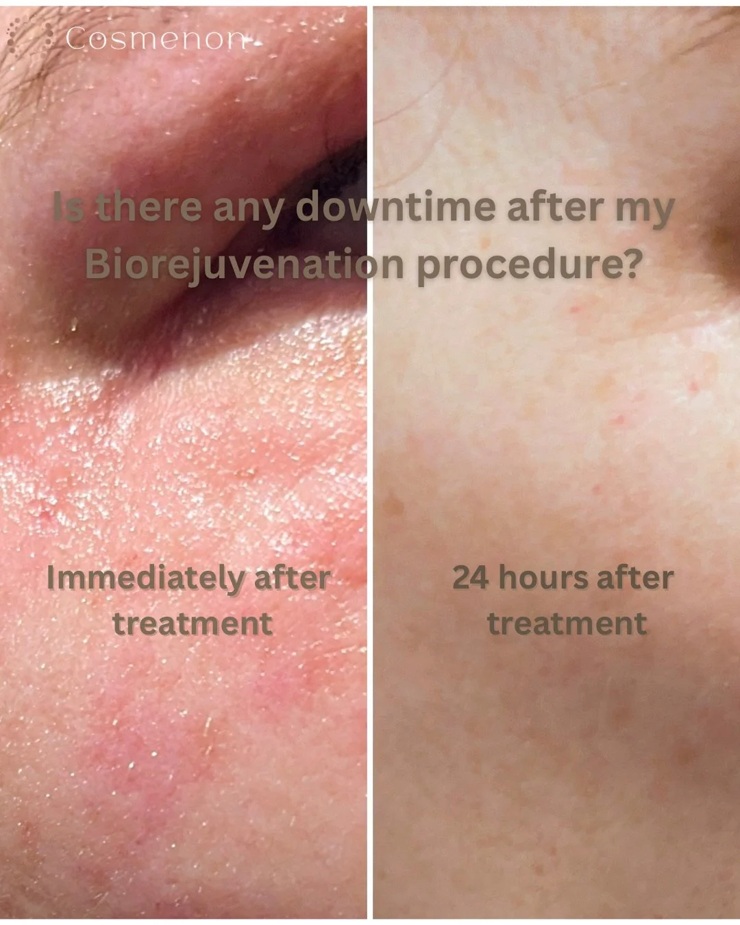 Comparison of skin before and after a biorejuvenation treatment, showing improved skin texture and reduced redness 24 hours after the procedure.