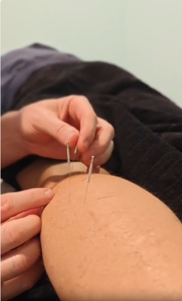 dry_needling.png