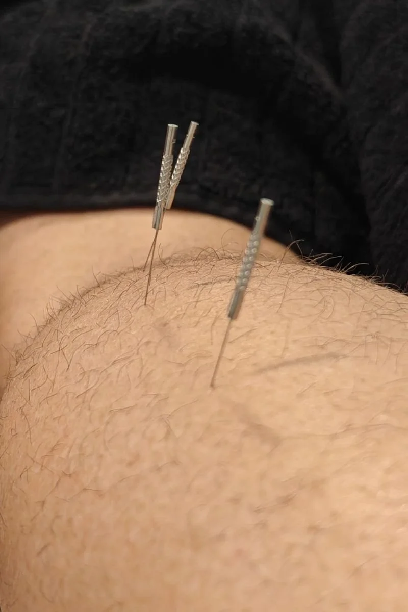 3 needles in a client's calf