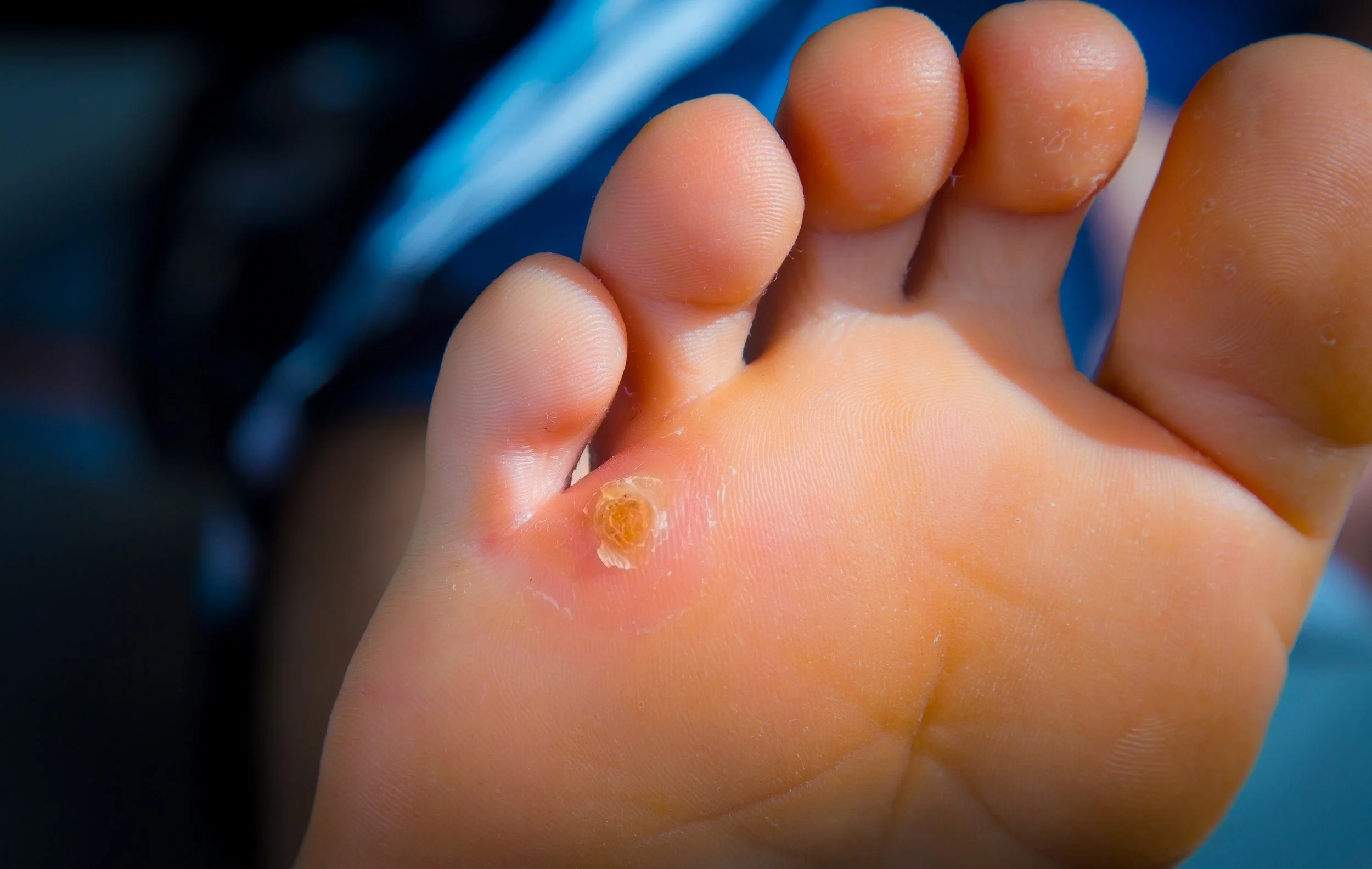 Close-up of a child's foot with a blister on the heel.