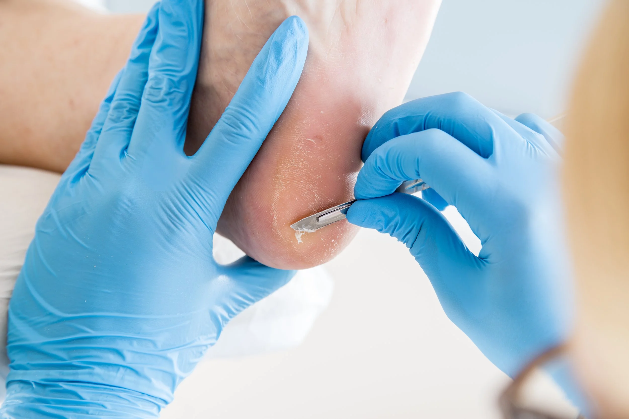 A medical professional wearing blue gloves is treating a patient's heel with a scalpel, possibly removing calluses or corns.