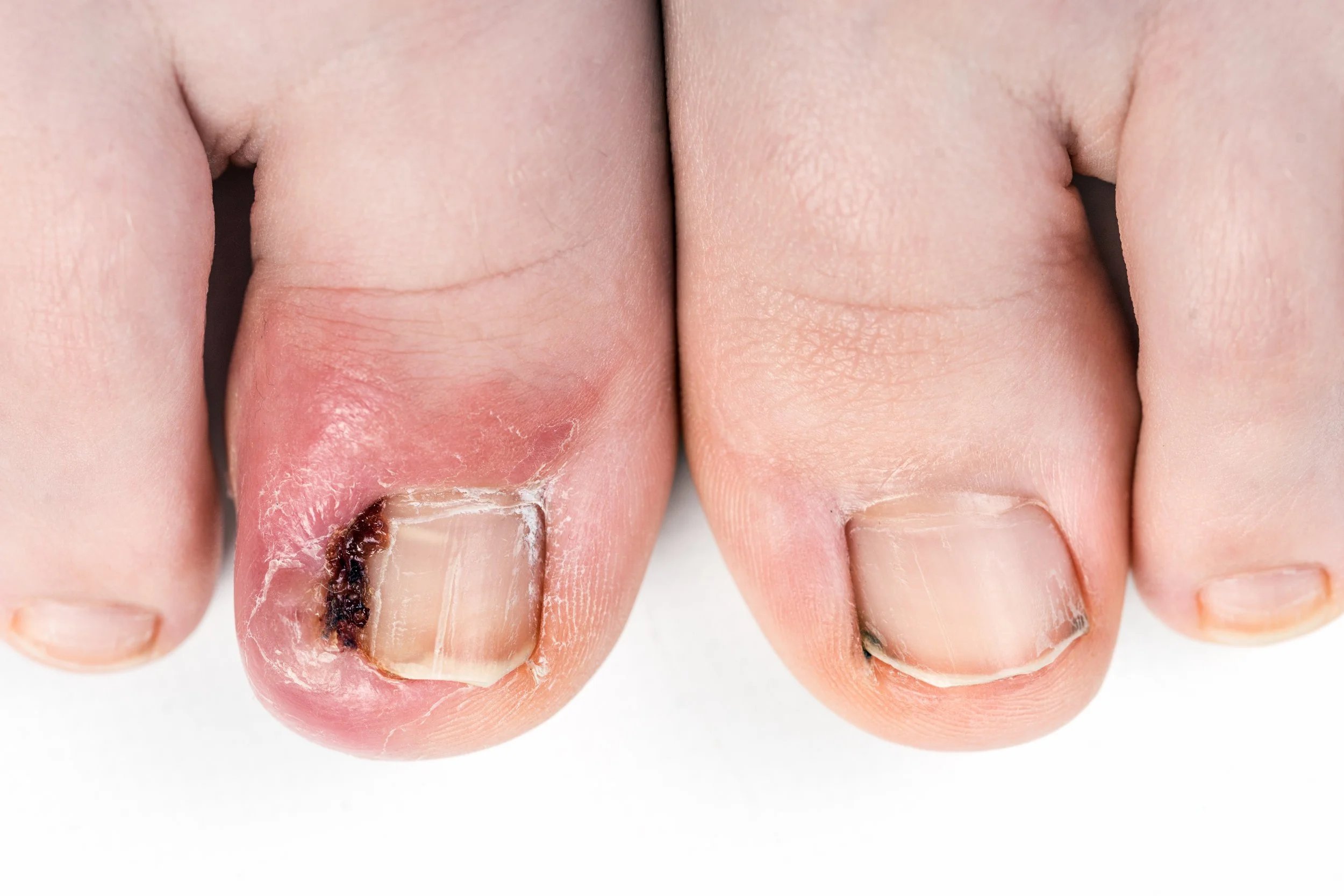 Close-up of a toenail with an infected, damaged, and decayed nail on the big toe, showing redness and white debris around the nail.