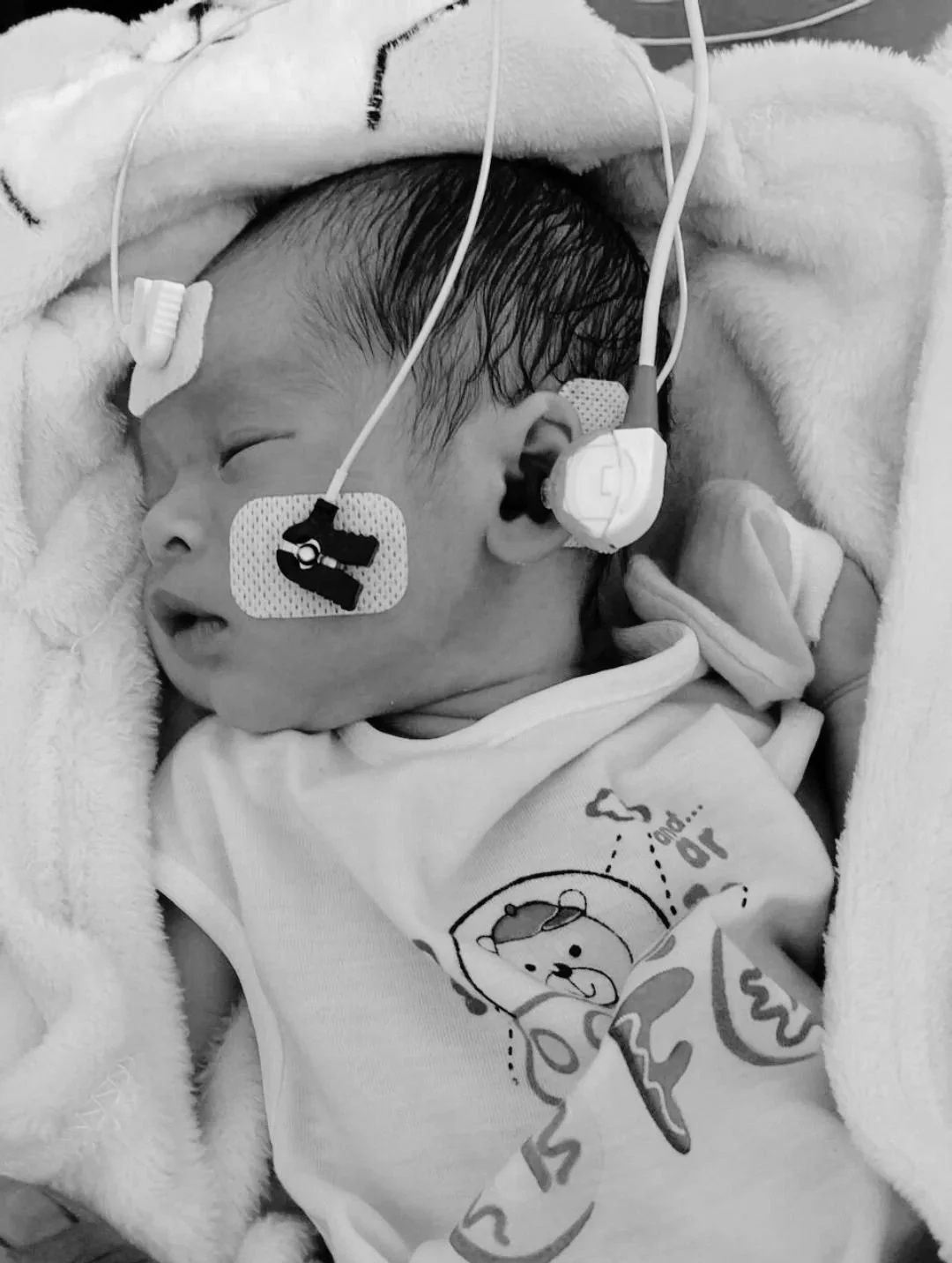 Close-up of a newborn baby with medical tubes and patches, lying on a pillow, wearing a printed shirt.
