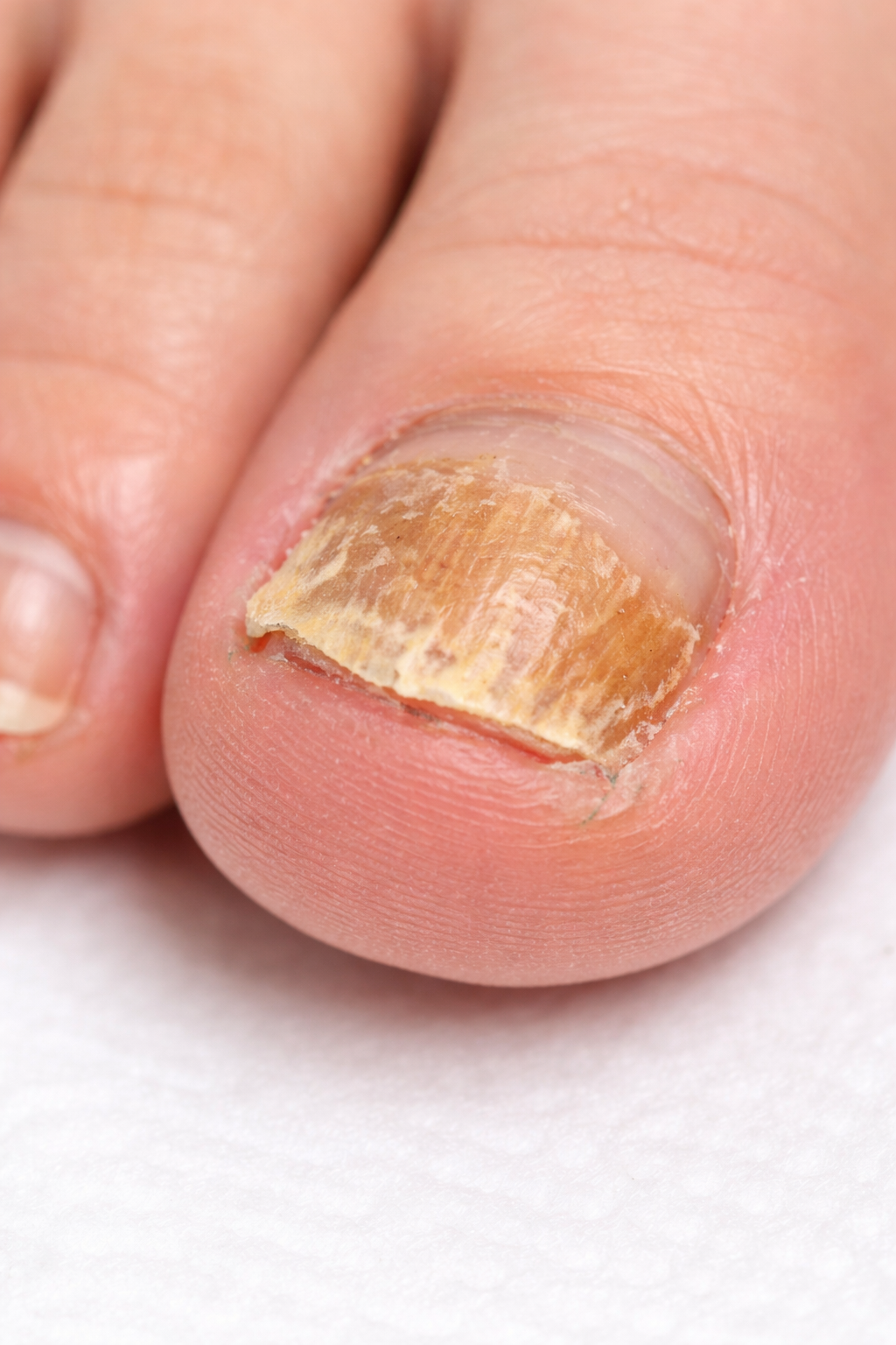 Close-up of a toenail with thick, discolored, and damaged nail plate indicating a fungal infection.