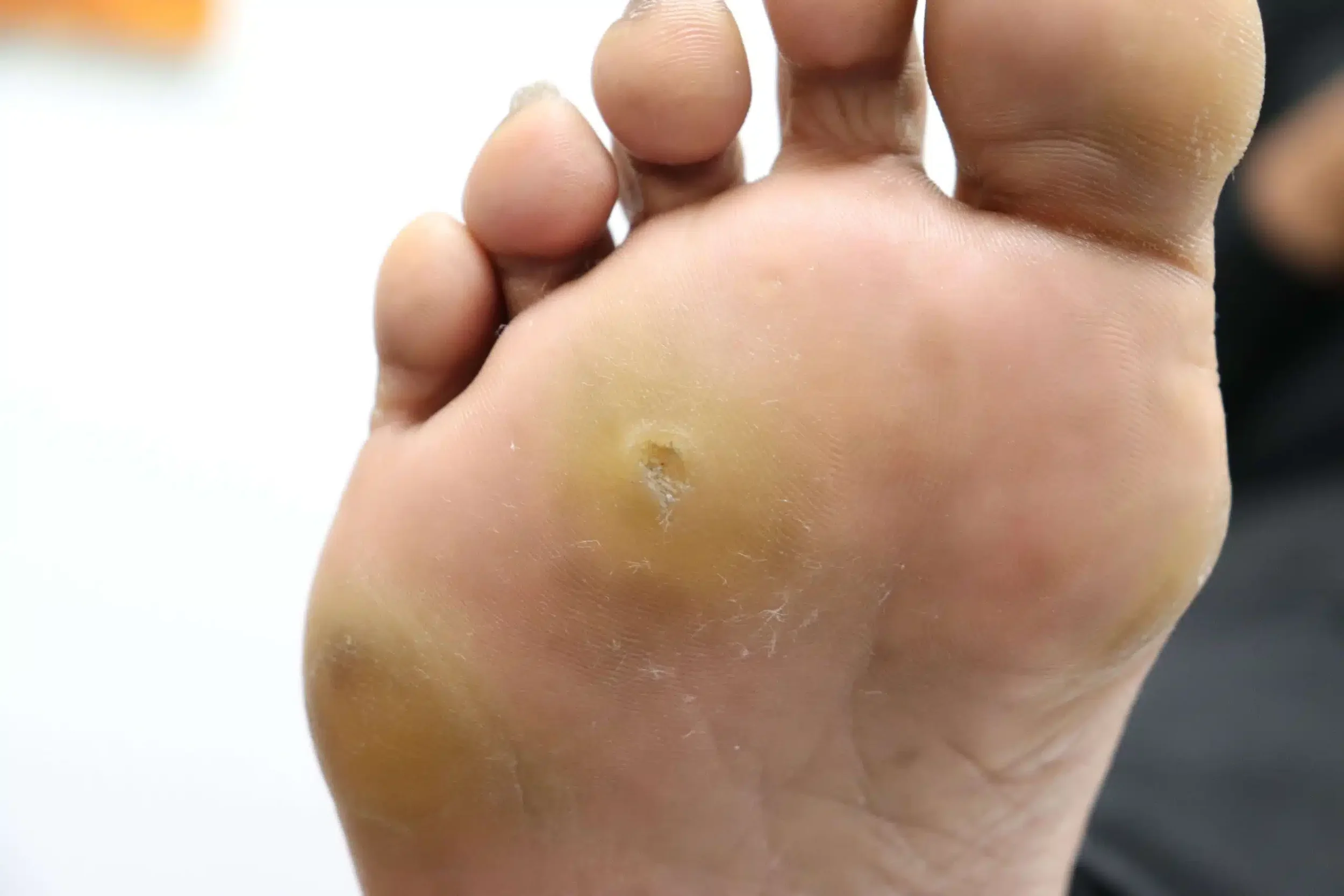 Close-up of a person's foot showing a blister or sore near the ball of the foot.