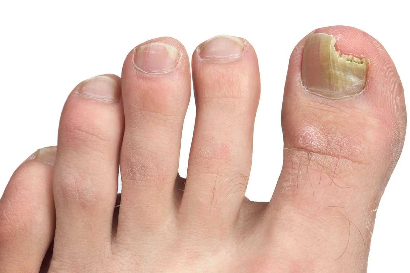 Close-up of a person's thumb with a large, peeling, damaged fingernail and dryness around the nail and cuticle.
