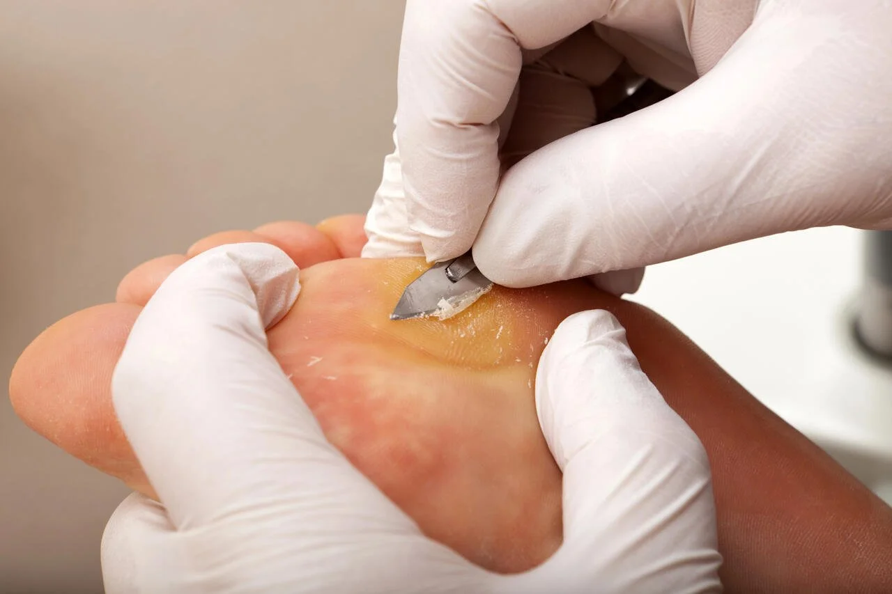 Close-up of a podiatrist using a scalpel to debride the thickened skin on a patient's heel, wearing gloves.