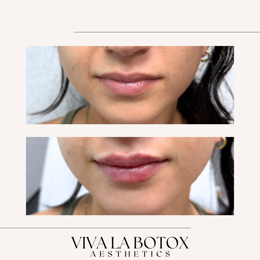 Viva La Botox | Before + After (1).png