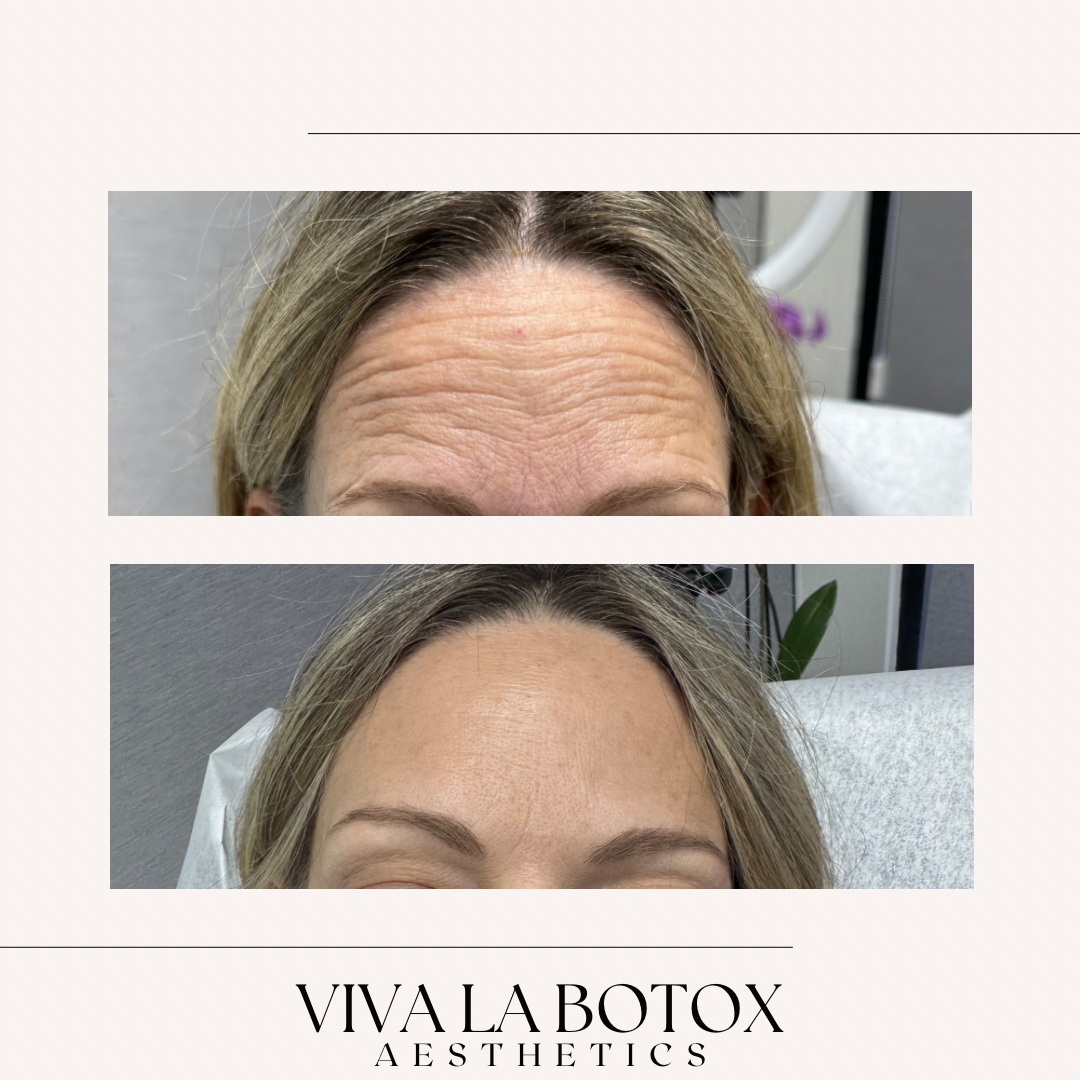 Viva La Botox | Before + After (11).png