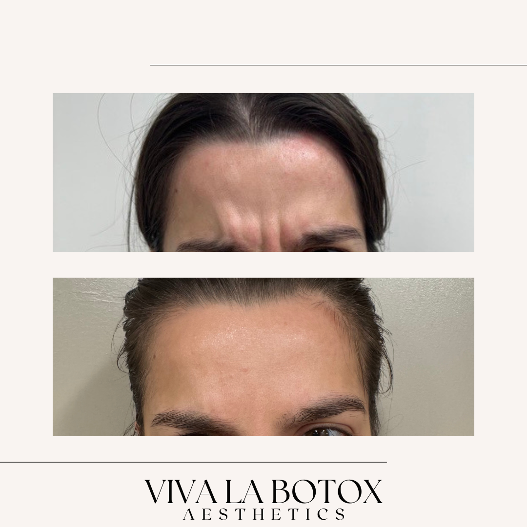 Viva La Botox | Before + After (10).png