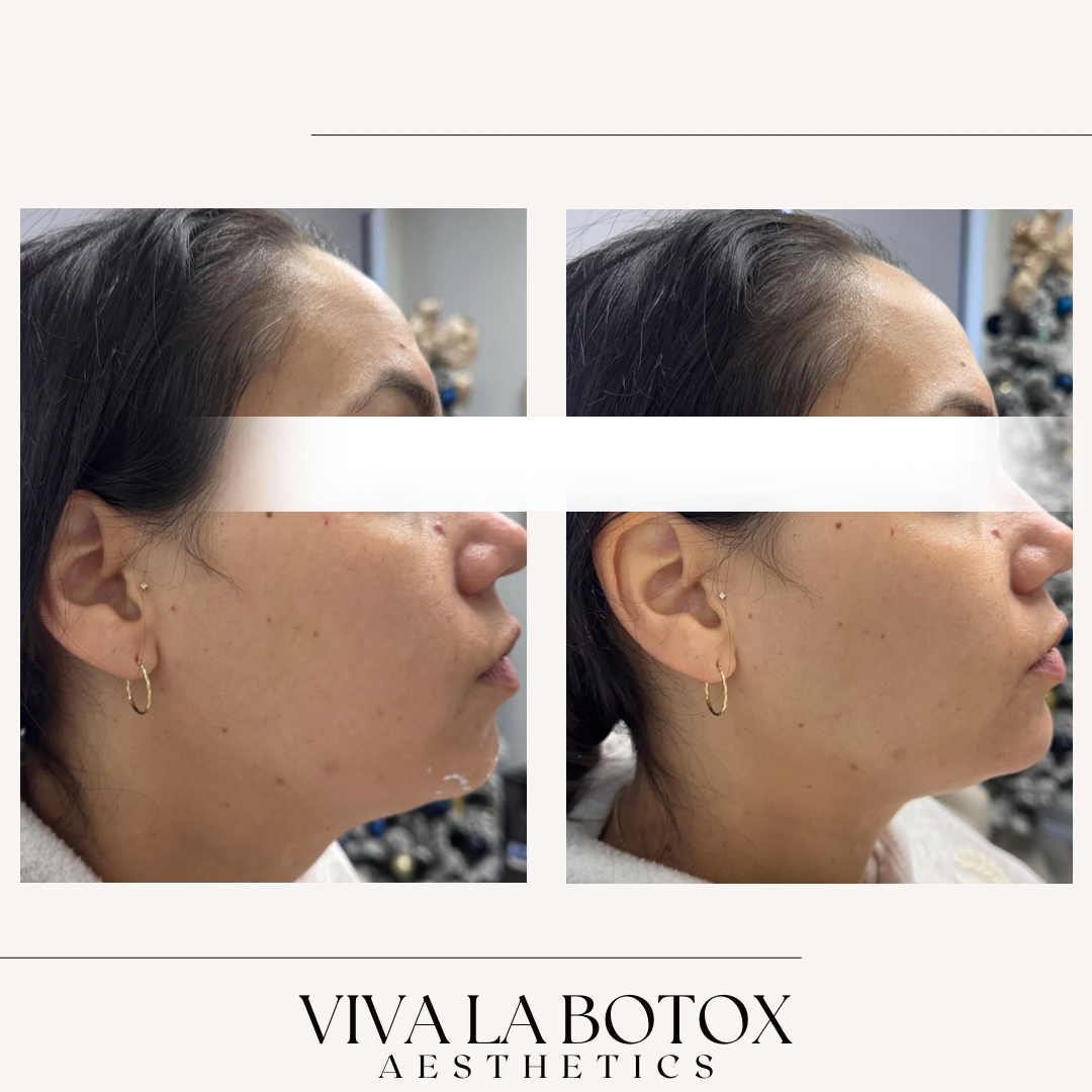 Viva La Botox | Before + After (13).png