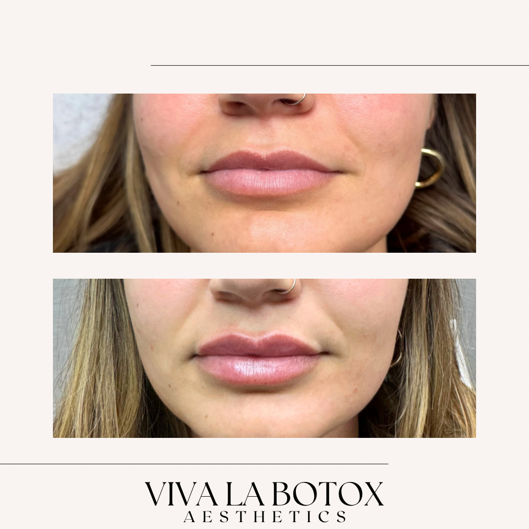 Viva La Botox | Before + After (8).png