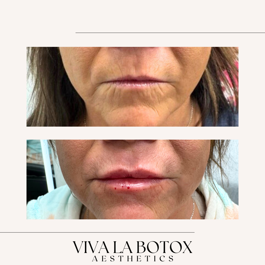 Viva La Botox | Before + After (7).png