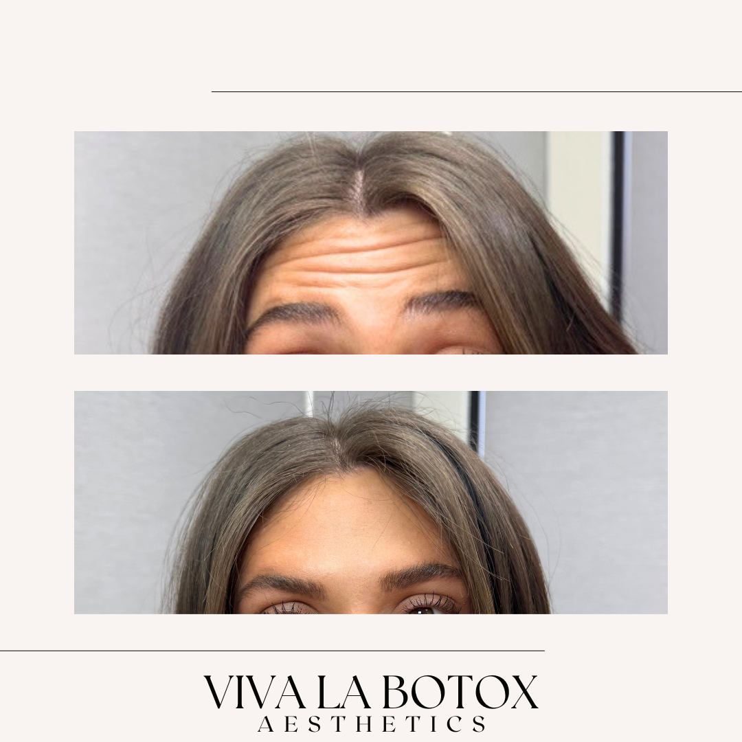 Viva La Botox | Before + After (4).png