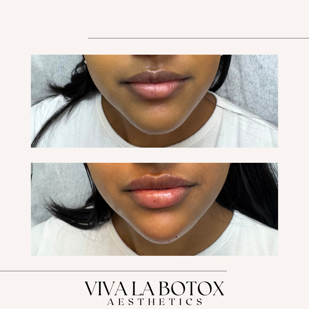 Viva La Botox | Before + After (5).png