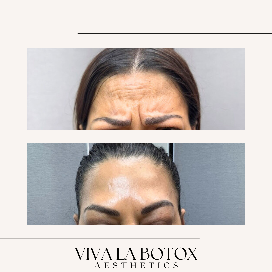 Viva La Botox | Before + After (2).png
