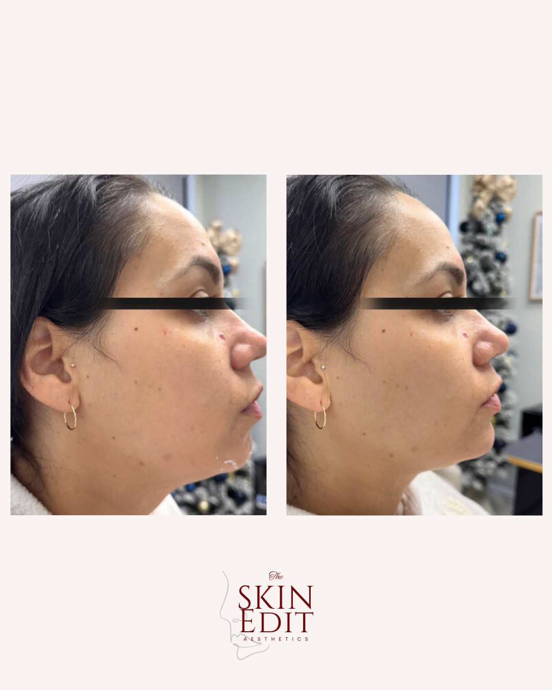 The Skin Edit Aesthetics | Before + After (1).PNG