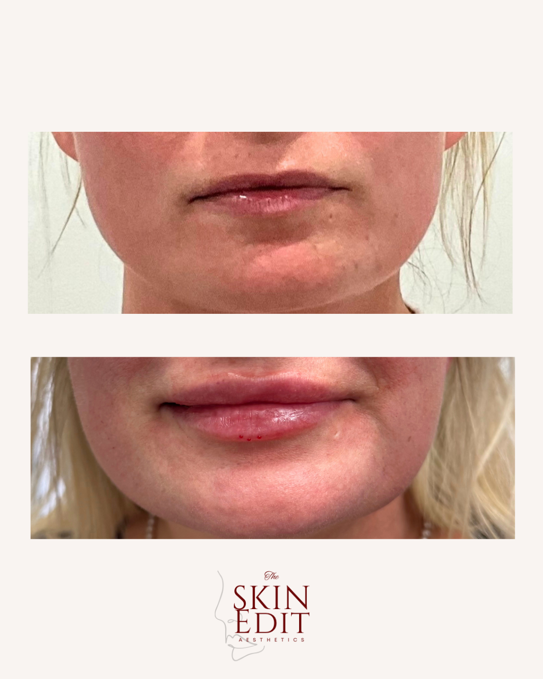 The Skin Edit Aesthetics | Before + After (2).PNG