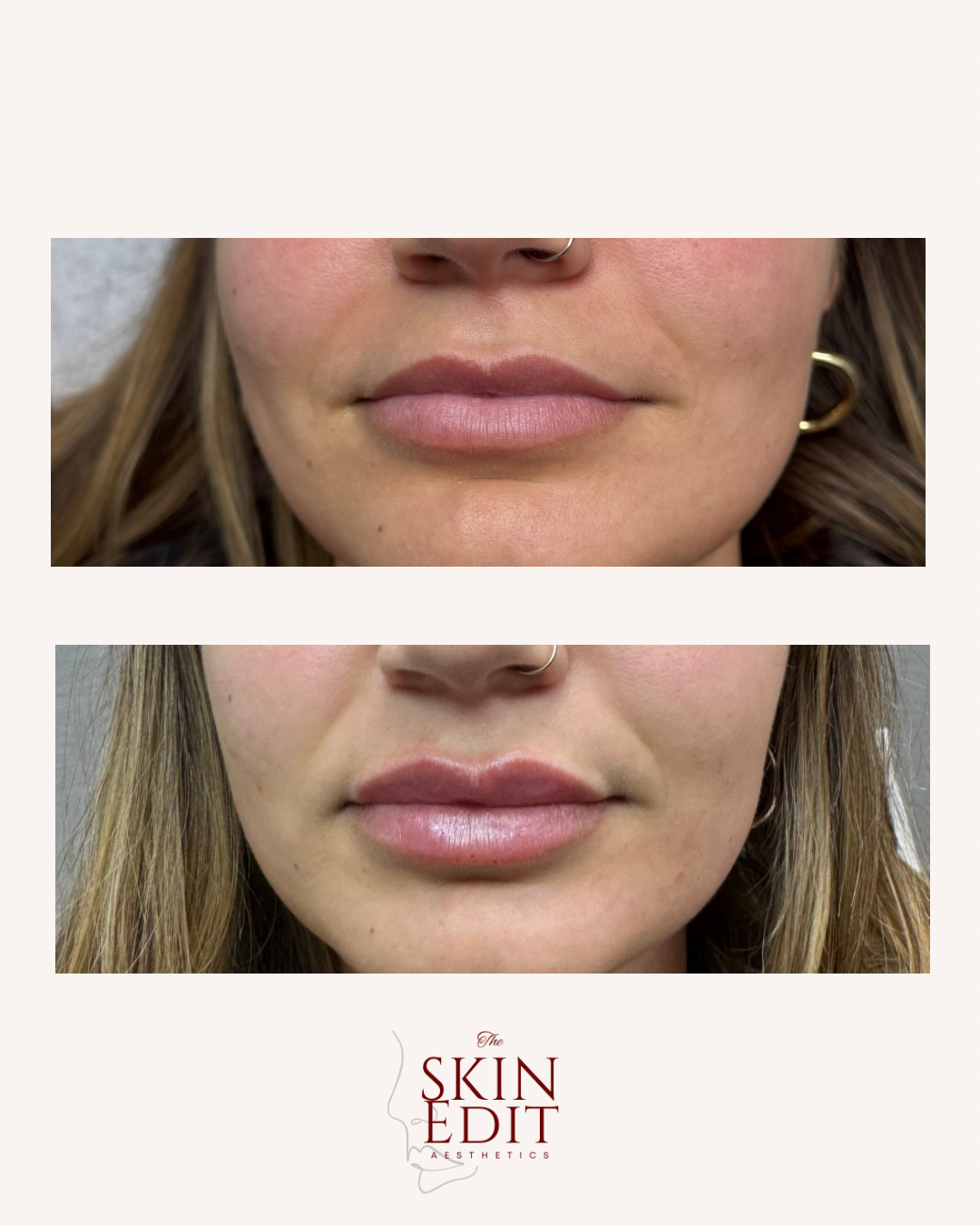 The Skin Edit Aesthetics | Before + After (6).PNG